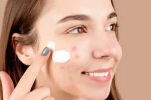 Skincare Kulit Berminyak Berjerawat